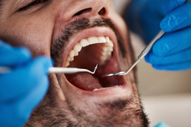 Best Emergency Wisdom Teeth Removal in Morrisville, VT